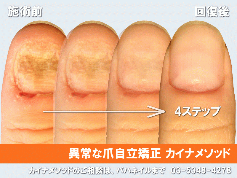 爪の駆け込み寺こと　バハネイル