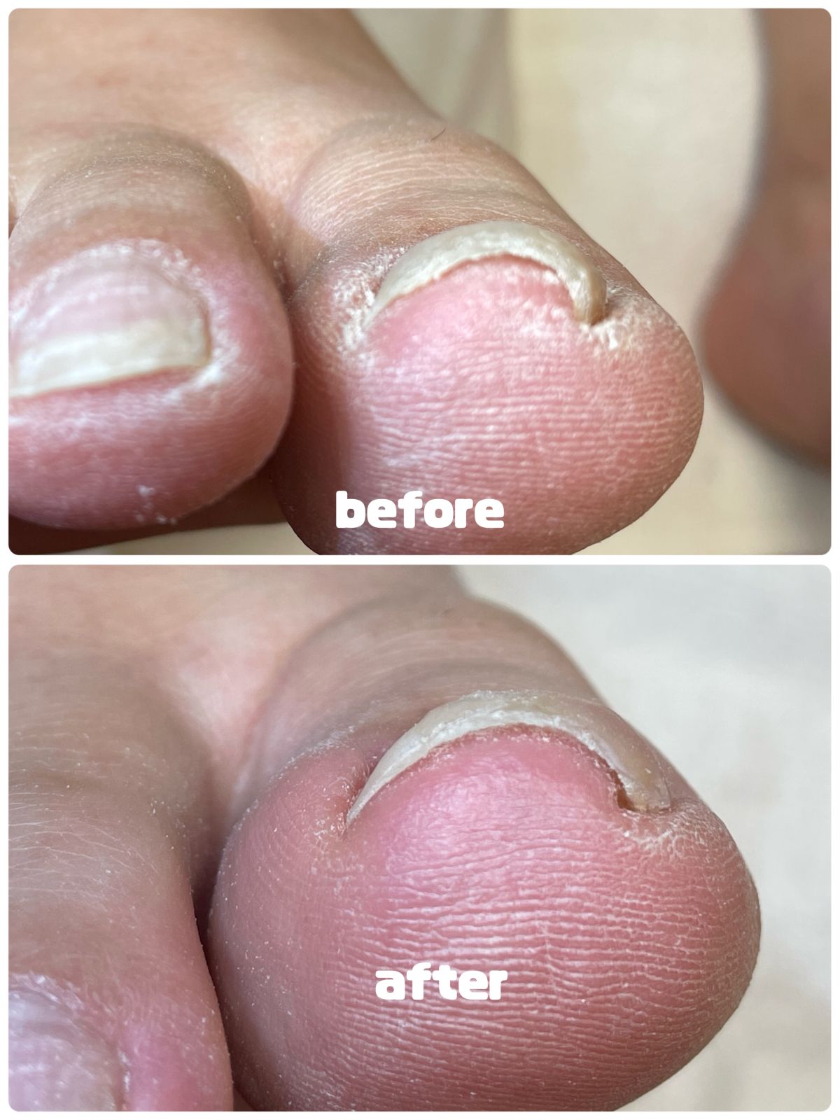 痛い巻き爪や魚の目の対処も致します