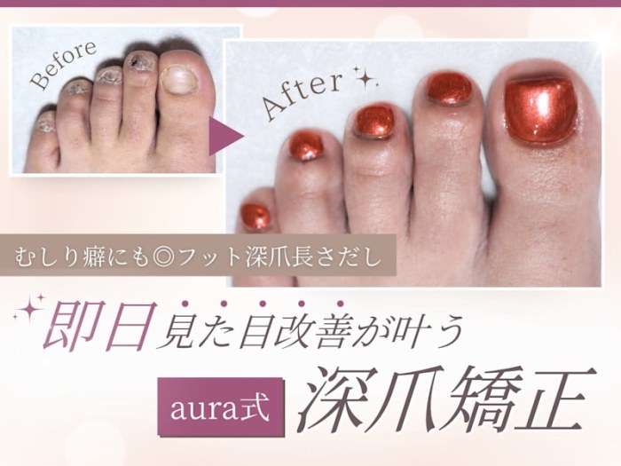 aura 深爪矯正 自爪育成 パラジェル登録サロン