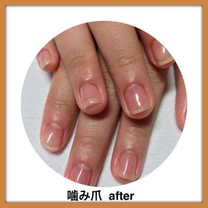 深爪　アフター